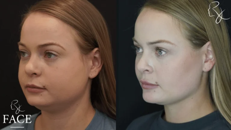 buccalFatRemoval1-left