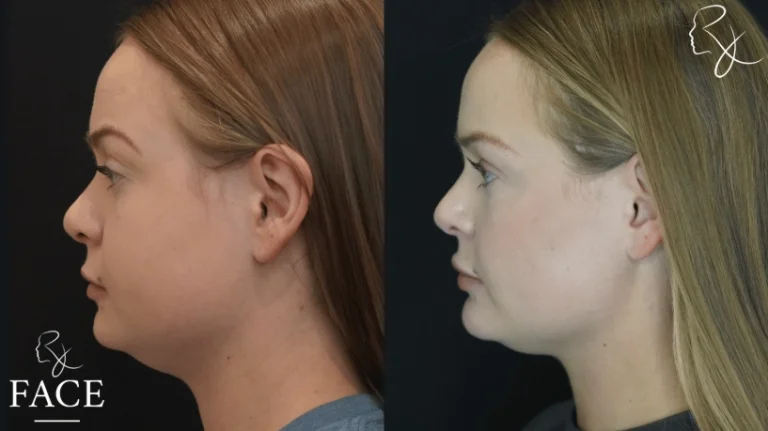 buccalFatRemoval1-leftProfile