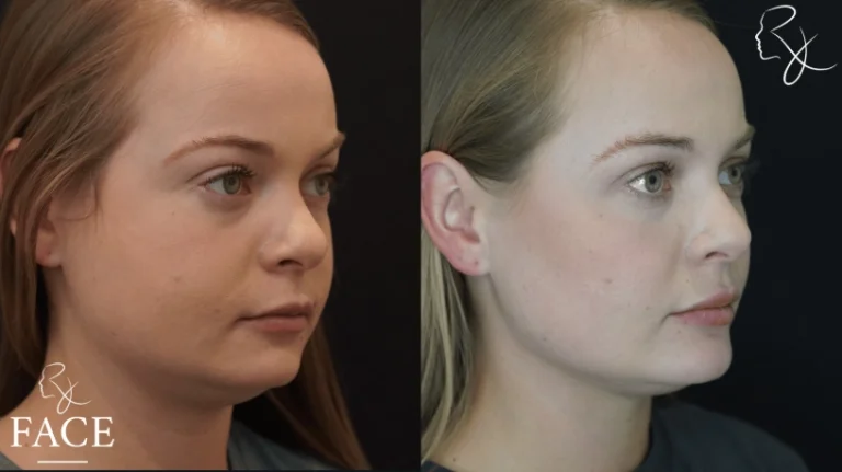 buccalFatRemoval1-right