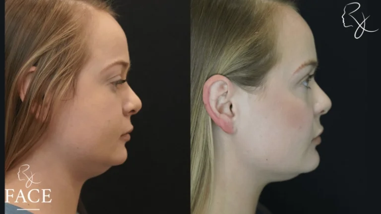 buccalFatRemoval1-rightProfile