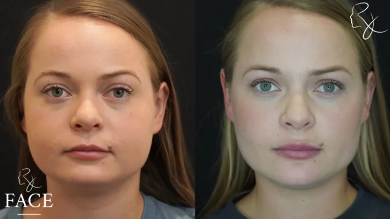 buccalFatRemoval1-straight