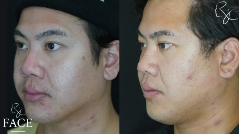 buccalFatRemoval2-left