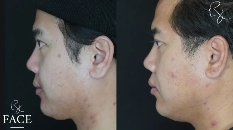 buccalFatRemoval2-leftProfile