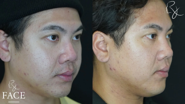 buccalFatRemoval2-right