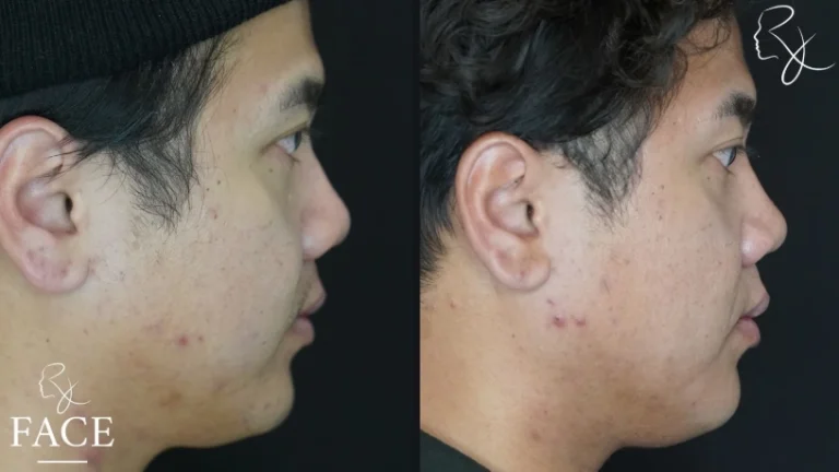 buccalFatRemoval2-rightProfile