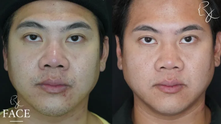 buccalFatRemoval2-straight