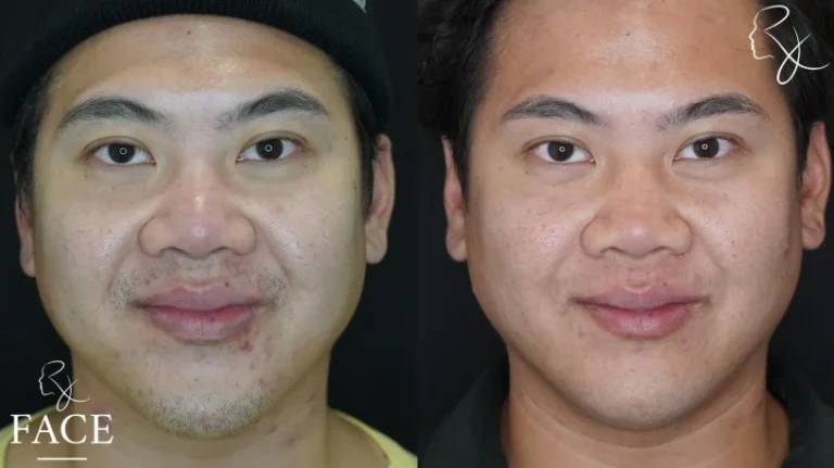 buccalFatRemoval2-straightSmile