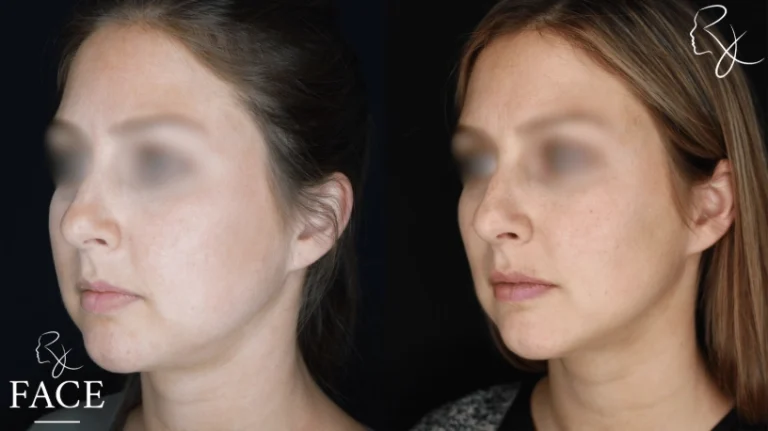 buccalFatRemoval3-left