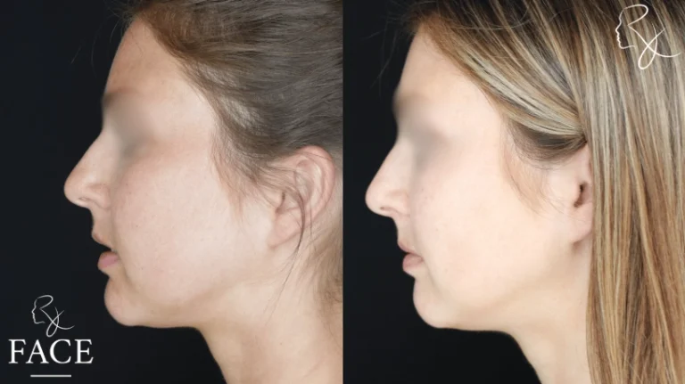 buccalFatRemoval3-leftProfile