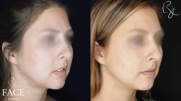 buccalFatRemoval3-right