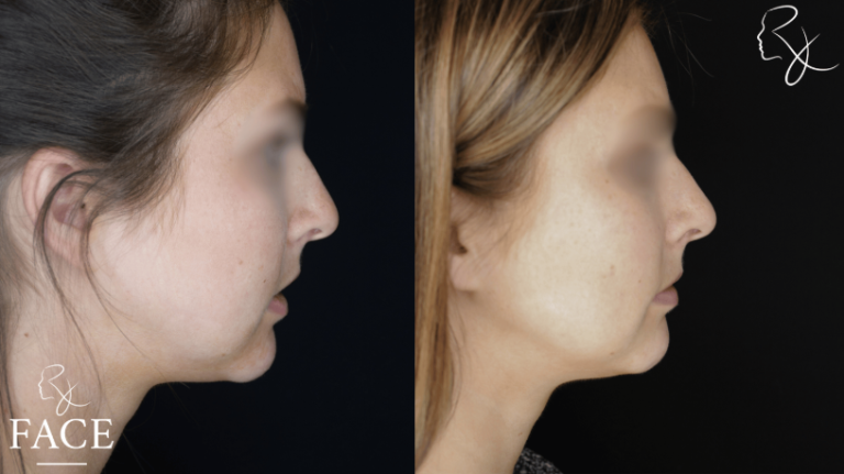 buccalFatRemoval3-rightProfile