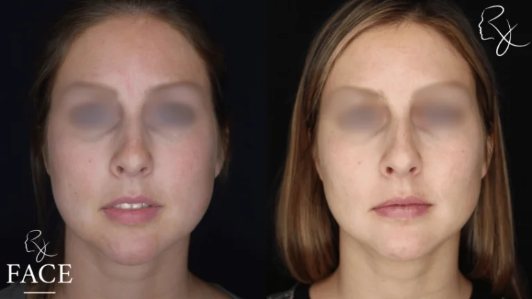 buccalFatRemoval3-straight