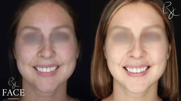 buccalFatRemoval3-straightSmile