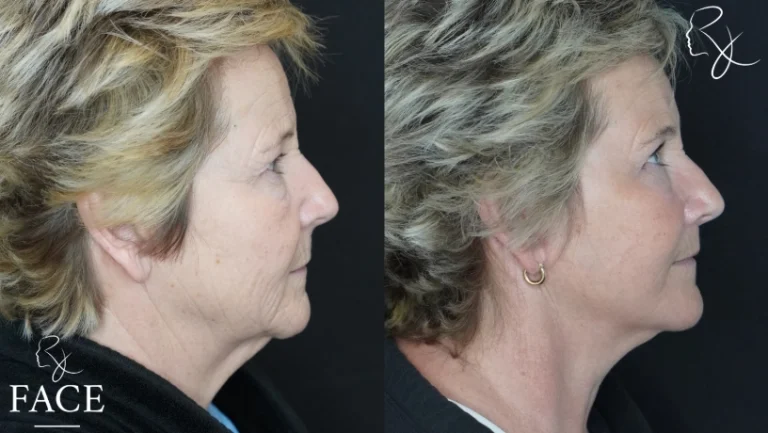 facelift11-rightProfile