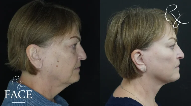 facelift2-rightProfile