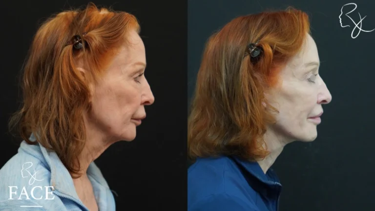 facelift4-rightProfile