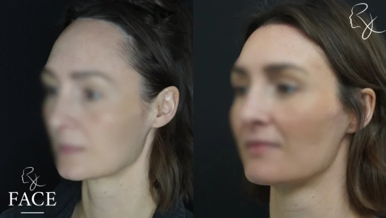 hairlineLowering1-left