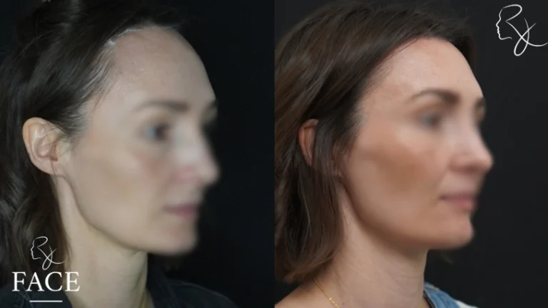 hairlineLowering1-right