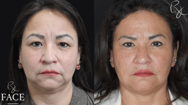 hairlineLowering3-forward