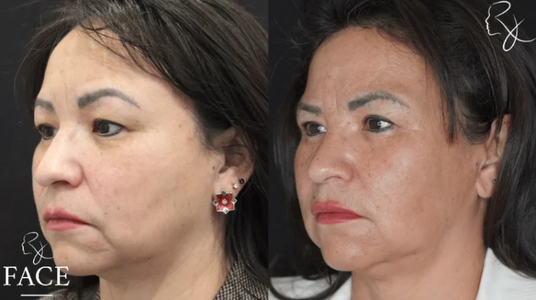 hairlineLowering3-left