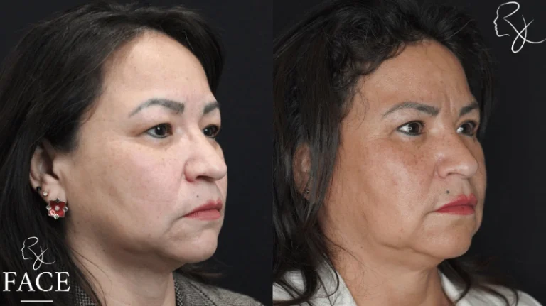 hairlineLowering3-right