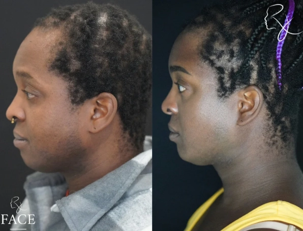 hairlineLowering4-leftProfile