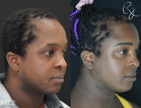 hairlineLowering4-right