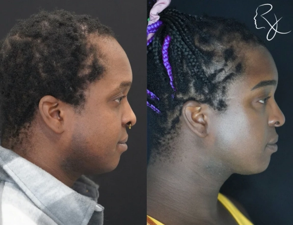 hairlineLowering4-rightProfile