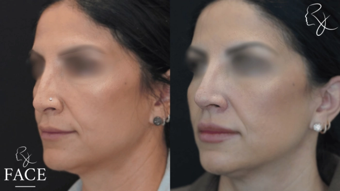 rivisionRhinoplasty1-left