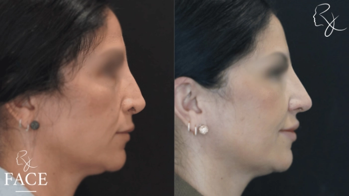 rivisionRhinoplasty1-rightProfile