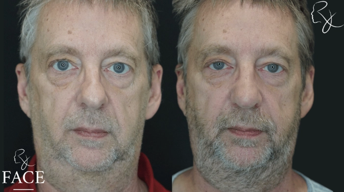 rivisionRhinoplasty2-forward