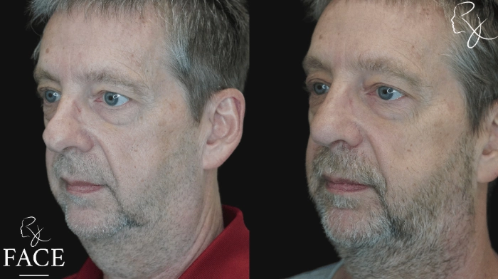 rivisionRhinoplasty2-left