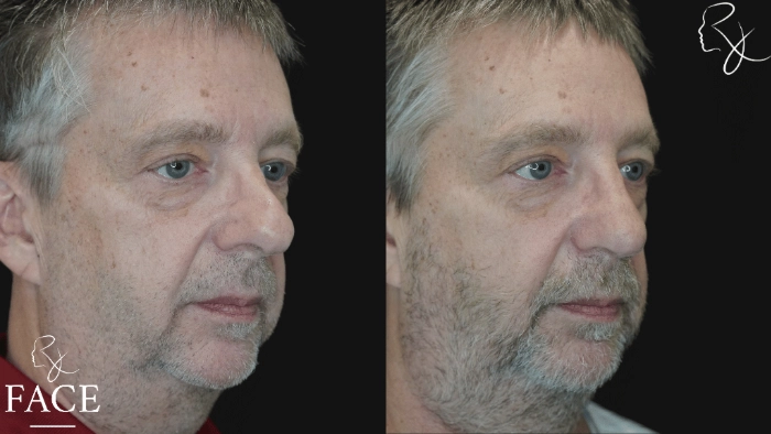 rivisionRhinoplasty2-right