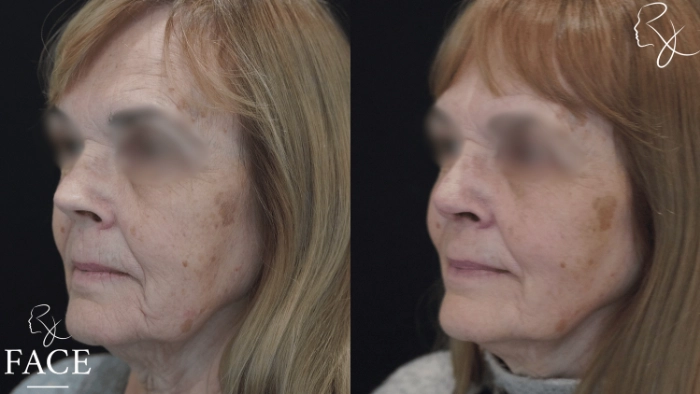 rivisionRhinoplasty3-left