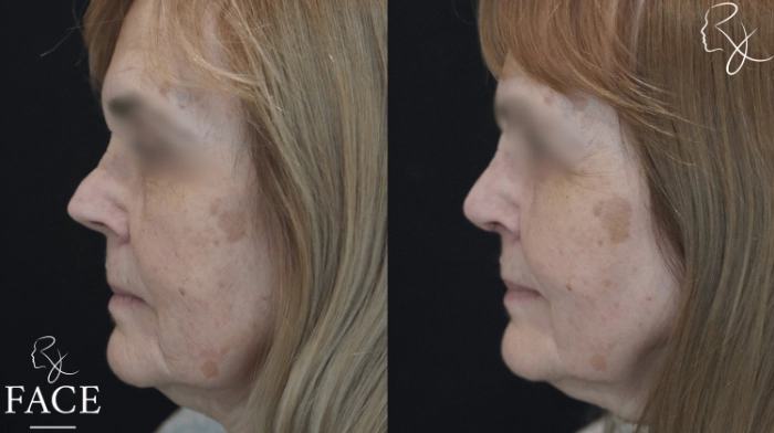 rivisionRhinoplasty3-leftProfile