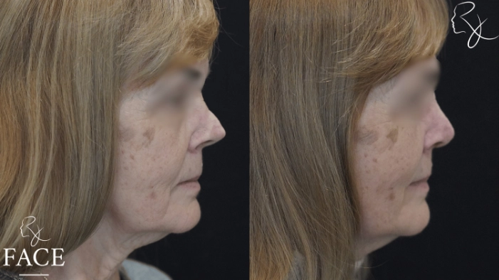 rivisionRhinoplasty3-rightProfile