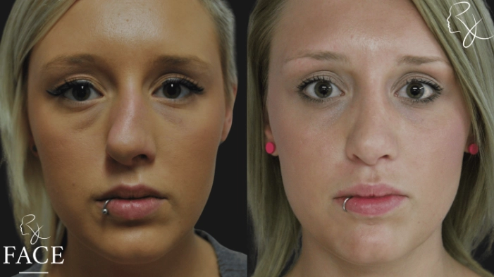 rivisionRhinoplasty4-forward