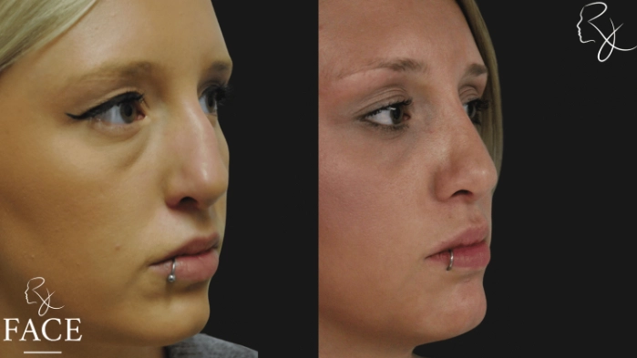 rivisionRhinoplasty4-right