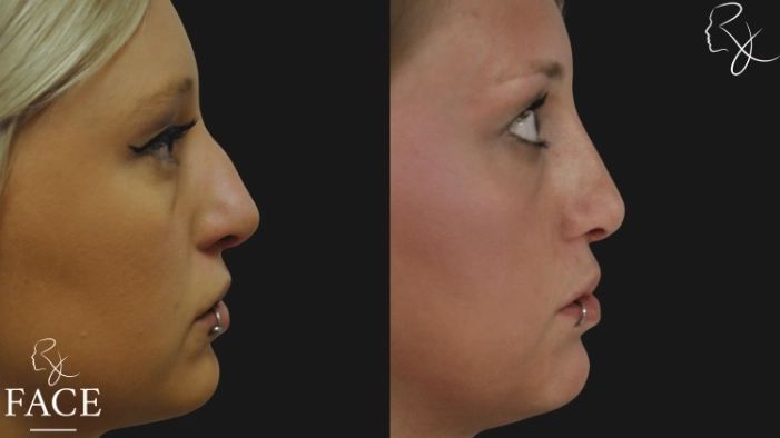 rivisionRhinoplasty4-rightProfile