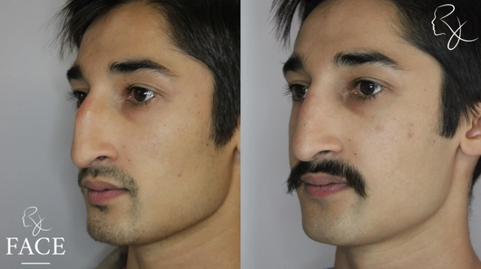 rivisionRhinoplasty5-left