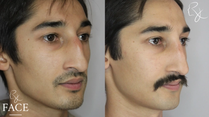 rivisionRhinoplasty5-right
