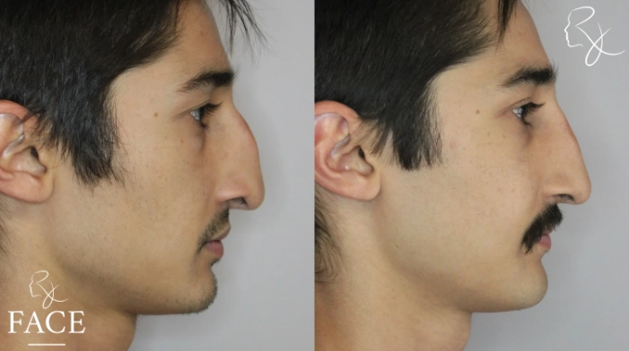 rivisionRhinoplasty5-rightProfile