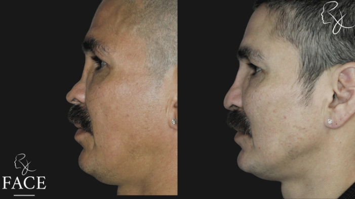 rivisionRhinoplasty6-leftProfile