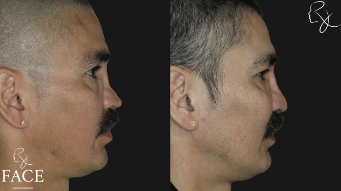 rivisionRhinoplasty6-rightProfile