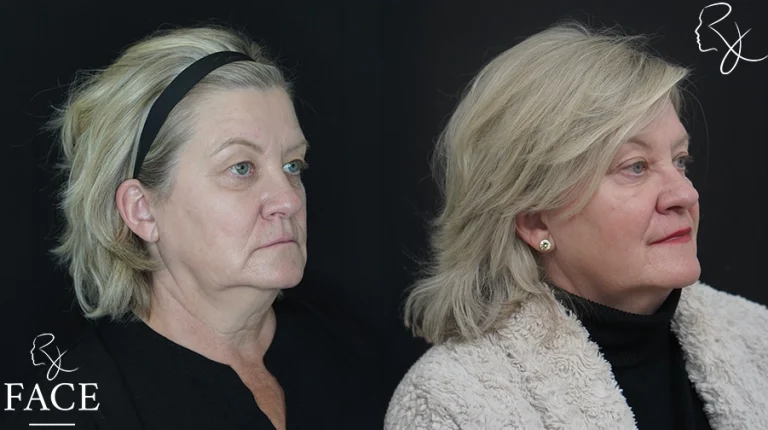 blephbrowMar1sideangleright