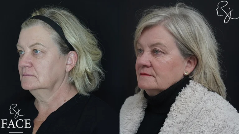 blephbrowMar1sideanglerleft