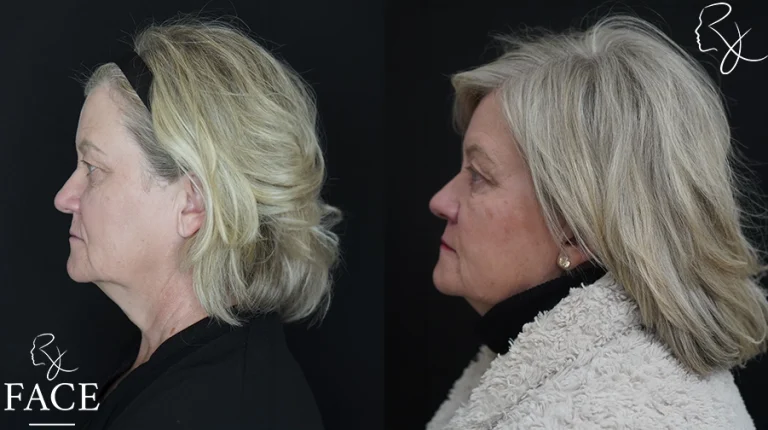 blephbrowMar1sideleft