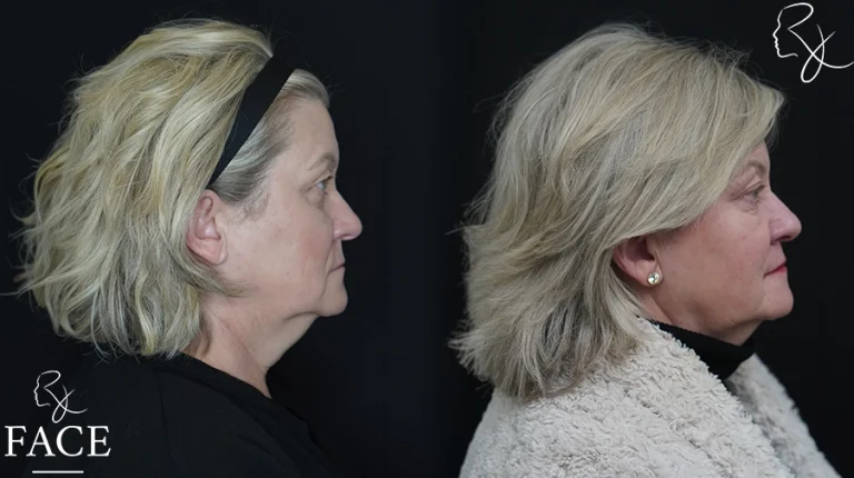 blephbrowMar1sideright