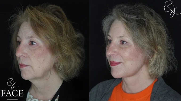 faceliftMar1sideangleleft