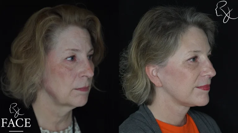 faceliftMar1sideangleright